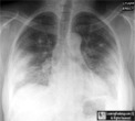 Silicone Embolism Syndrome